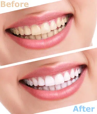 before and after look at the teeth whitening results from Florham Park Smile Lounge