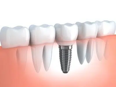 diagram of how a dental implant is placed