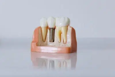 model of how dental implants work