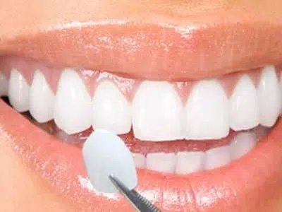 dental veneers being placed on a patient's teeth