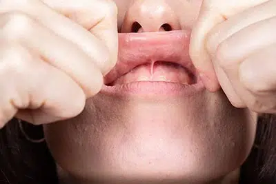 patient showing where a frenectomy takes place