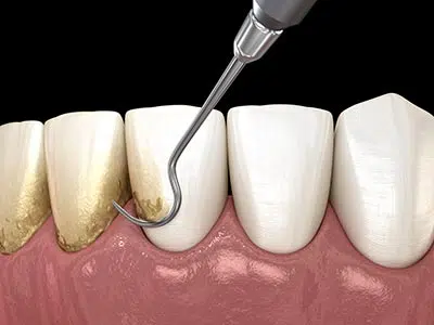 showing how a deep cleaning works for patient's teeth with gum disease