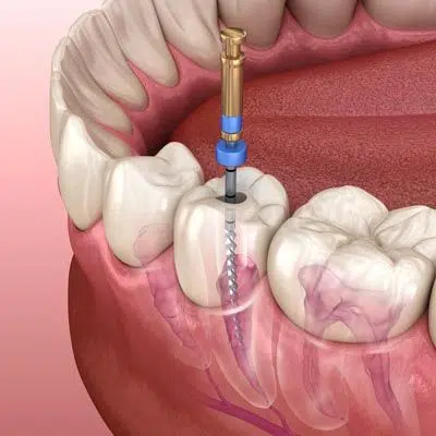 diagram showing how a root canal is performed